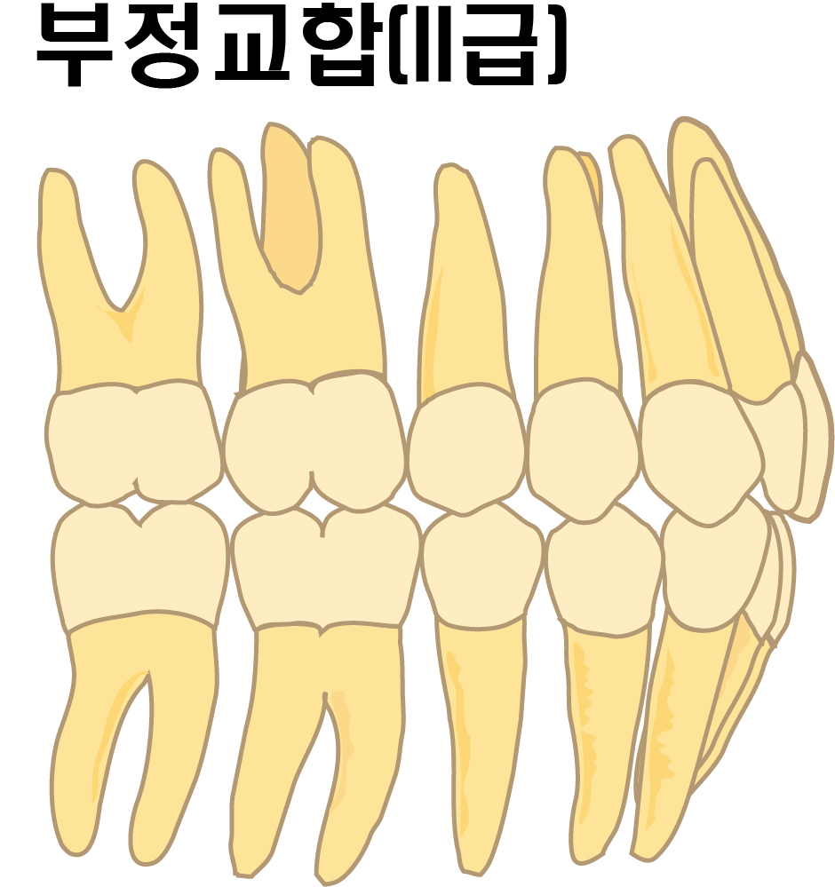 어금니가 1대1로 물리는 부정교합