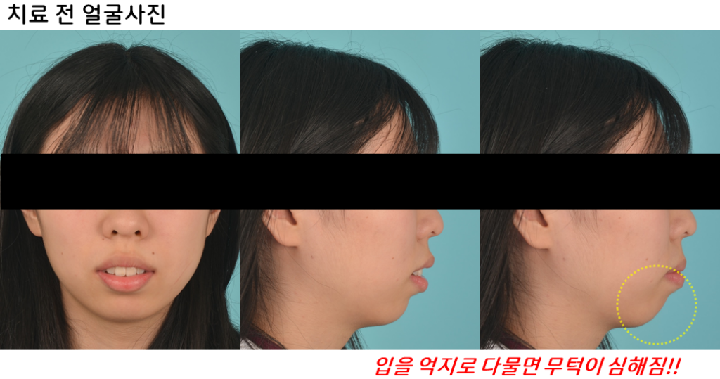 15세 장안모형 무턱 중학생 환자의 비수술 전체치열 압하교정 30개월 치료 전 앞모습과 옆모습 사진