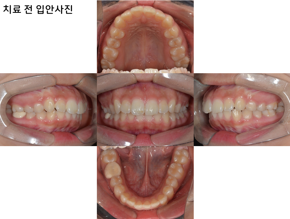 15세 장안모형 무턱 중학생 환자의 비수술 전체치열 압하교정 30개월 치료 전 구강 내 사진
