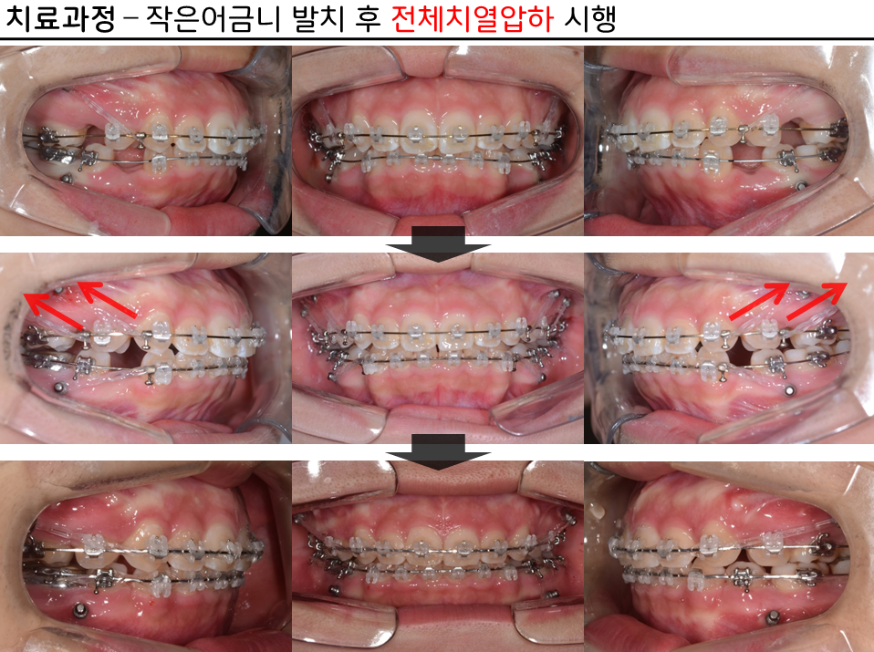 15세 장안모형 무턱 중학생 환자의 비수술 전체치열 압하교정 30개월 치료 과정 구강 내 사진