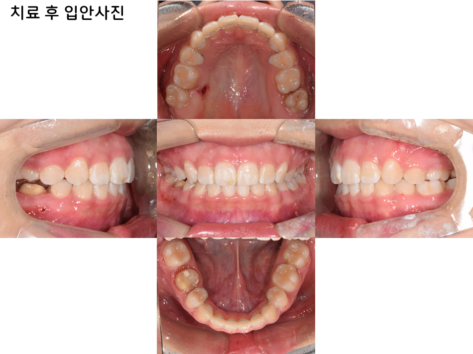 15세 장안모형 무턱 중학생 환자의 비수술 전체치열 압하교정 30개월 치료 후 구강내 사진