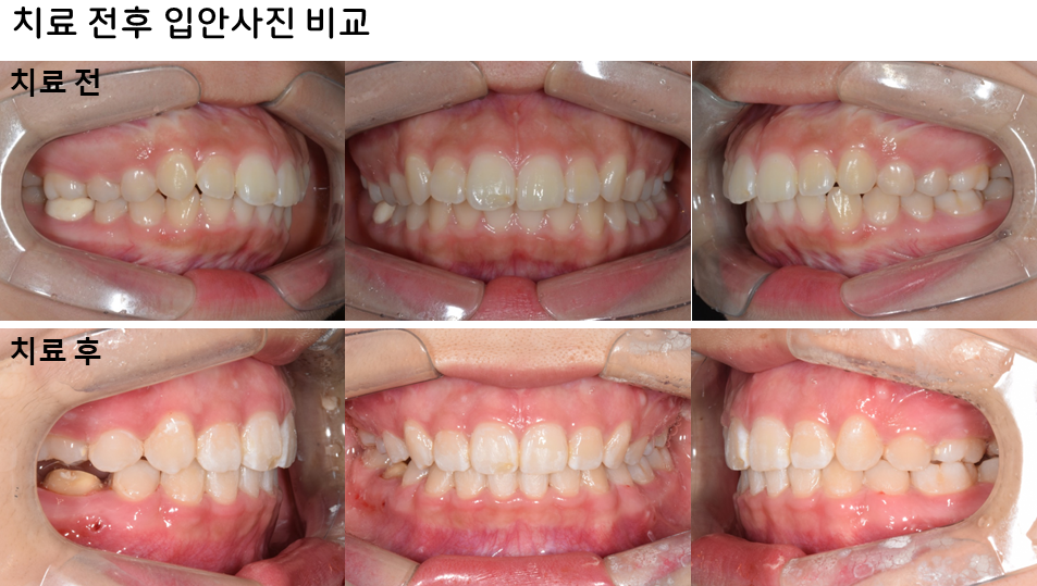 15세 장안모형 무턱 중학생 환자의 비수술 전체치열 압하교정 30개월 치료 전후 구강 내 교합 변화 비교 사진
