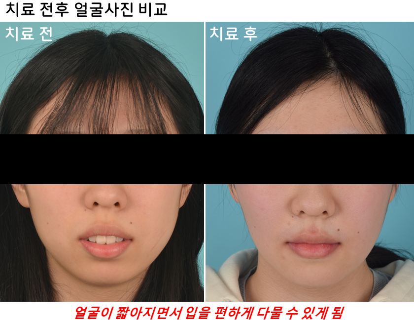 15세 장안모형 무턱 중학생 환자의 비수술 전체치열 압하교정 30개월 치료 전후 앞모습 변화 비교 사진