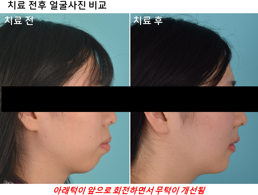 15세 장안모형 무턱 중학생 환자의 비수술 전체치열 압하교정 30개월 치료 전후 옆모습 변화 비교 사진