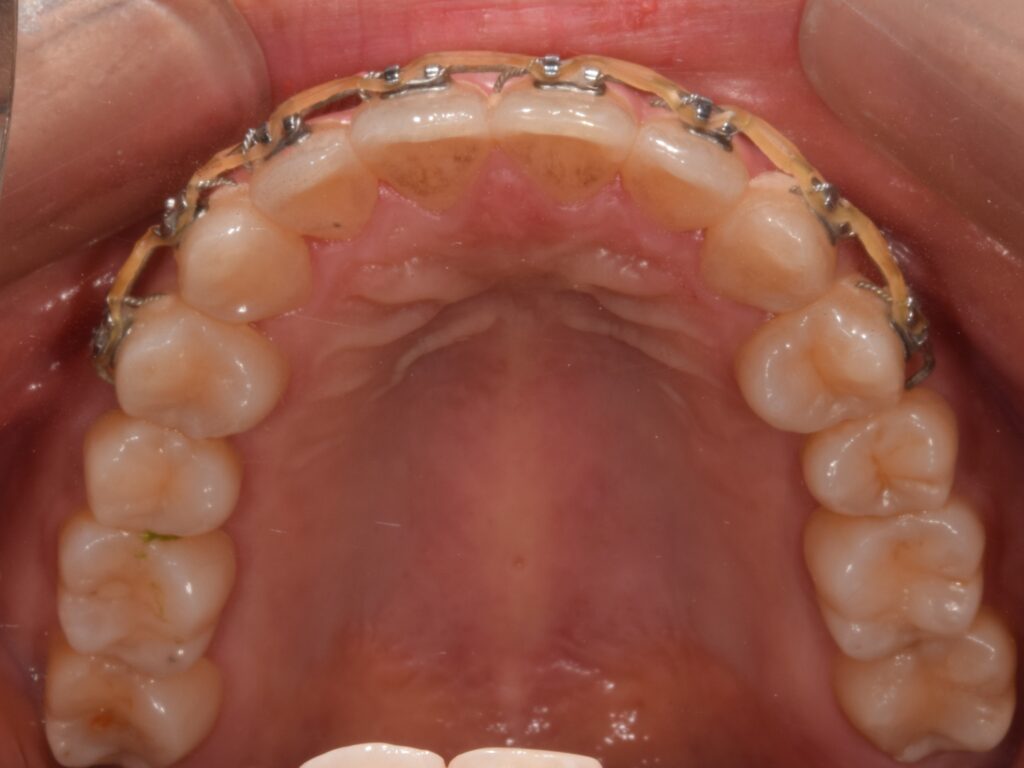 장치가 전체치아에 있는 전체교정